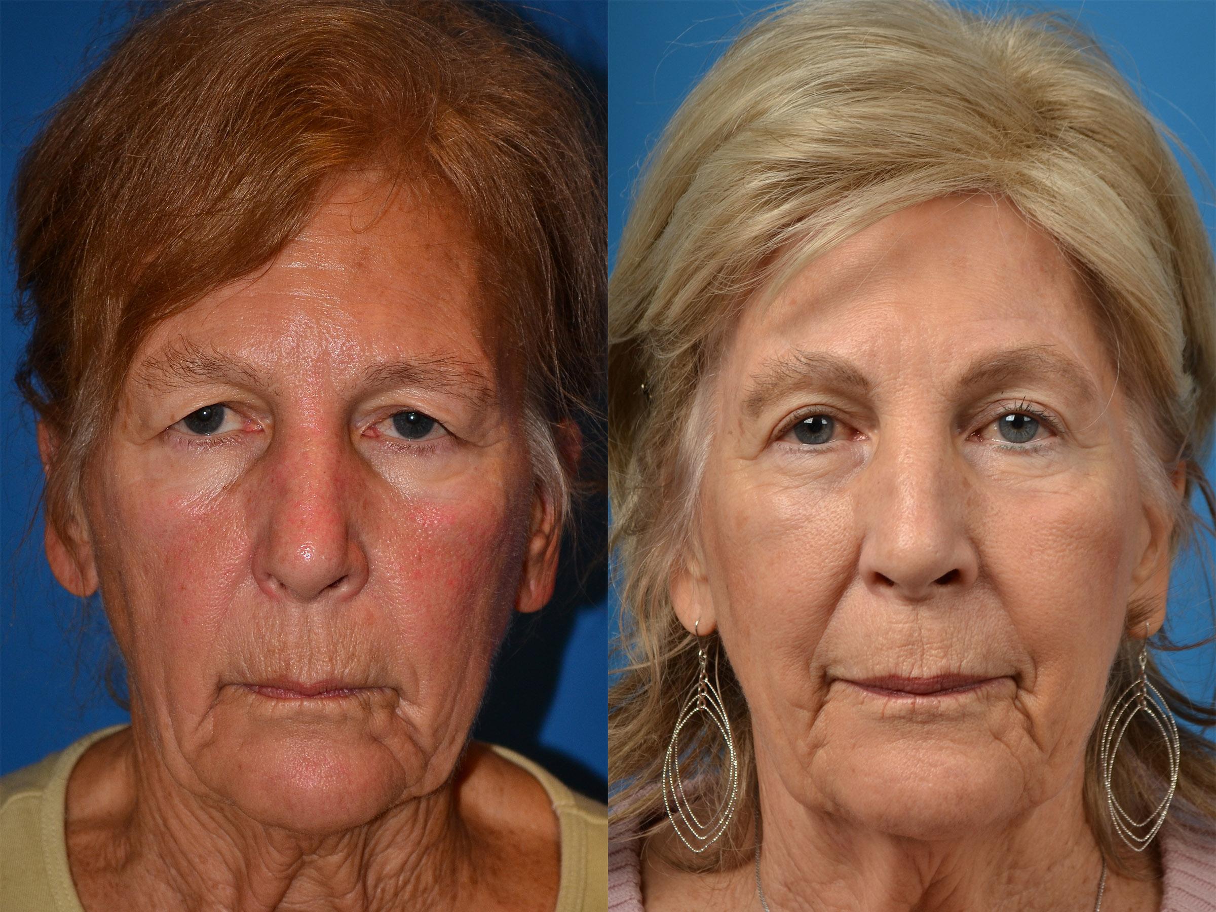 brow-lift-photos-melbourne-fl-patient-55025